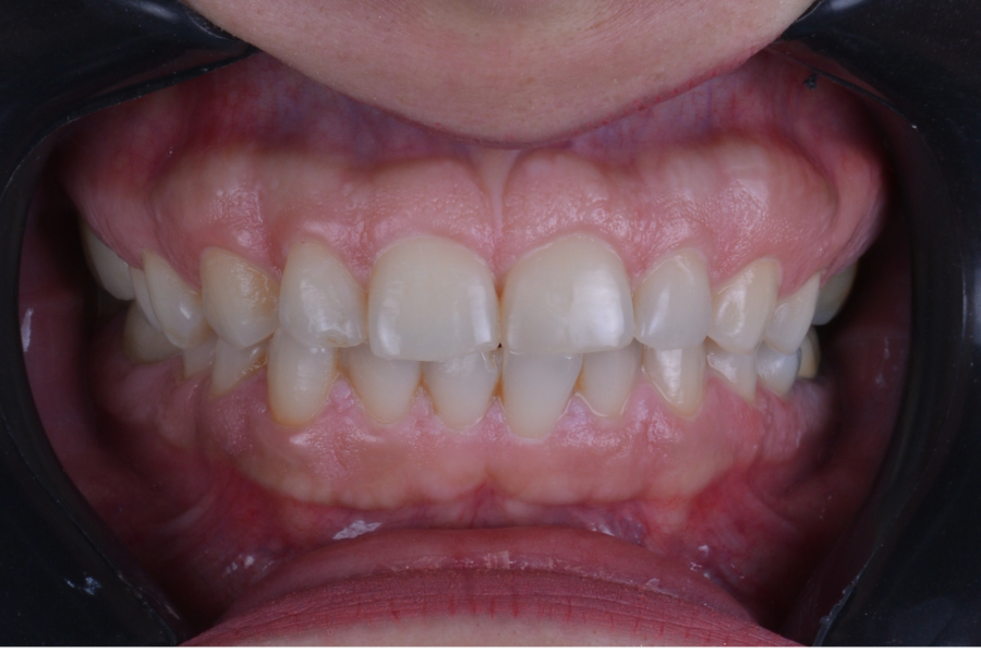 قبل تغير لون و شكل الأسنان لإعادة تأهيل الابتسامة.